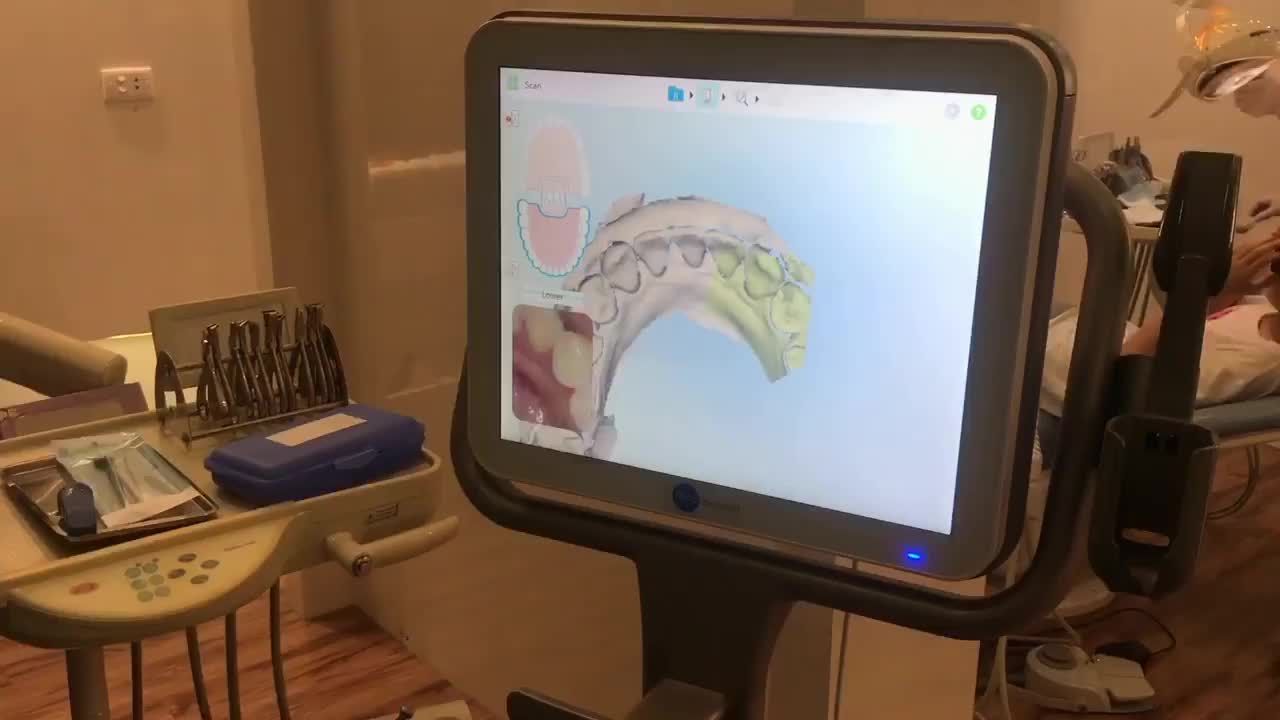 Hình ảnh khách hàng lựa chọn phương pháp Niềng răng vô hình - Invisalign® đang được scan hàm răng trên máy itero.