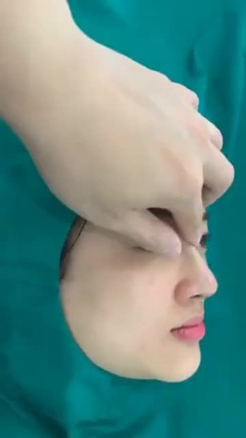 Cuối tuần đông khách Quá trình nâng mũi - Biến mũi thấp tẹt thành cao tây