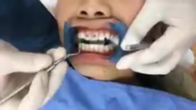 Gắn mắc cài chỉnh nha cho bạn Phương Ly.