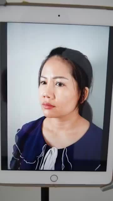 CA MŨI CẤU TRÚC SỬA LẠI SAU 7 NGÀY TÁI KHÁM - MŨI VÀO FORM ỔN ĐỊNH
