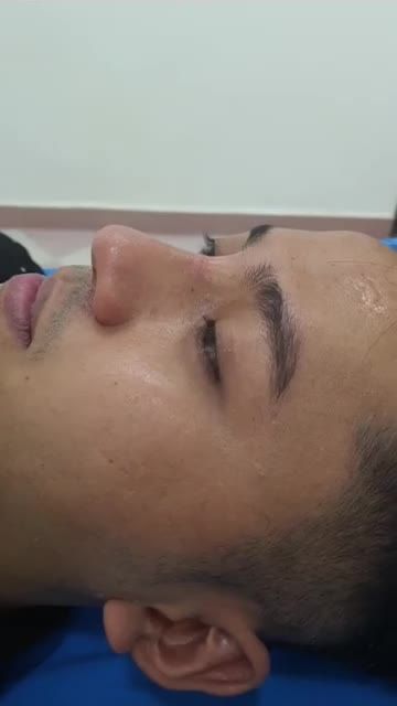 Nâng mũi bán cấu trúc 2 lớp Dáng Lline cao tây Quá đẹp cho em trai Kiên Giang