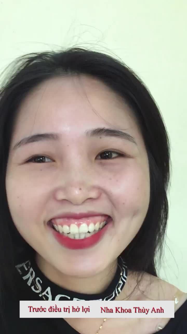 PHẪU THUẬT CƯỜI HỞ LỢI KHÔNG TÁI PHÁT.