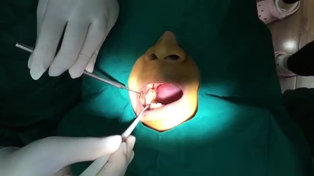 Cấy chân răng nhân tạo cho anh Vinh tại Nha Khoa Thuỳ Anh.