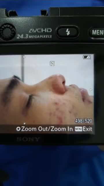 Nâng mũi bán cấu trúc đa lớp