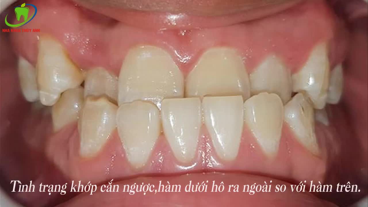 KHỚP CẮN NGƯỢC, MÓM NIỀNG RĂNG LÀ CÁCH GIẢI QUYẾT TRIỆT ĐỂ NHẤT