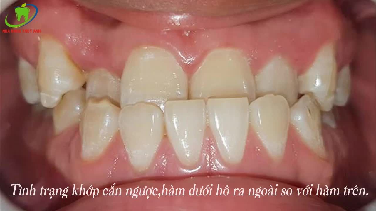 KHỚP CẮN NGƯỢC, MÓM NIỀNG RĂNG LÀ CÁCH GIẢI QUYẾT TRIỆT ĐỂ NHẤT