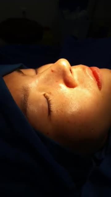 Nâng mũi bán cấu trúc đa lớp Dáng Lline cao tây