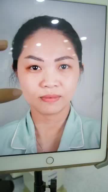 NÂNG MŨI SỤN SURGIFORM VỪA THỰC HIỆN XONG