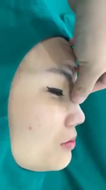 Thẩm mỹ chất lượng Hàn - chi phí Việt nâng mũi chỉ với từ 5tr9