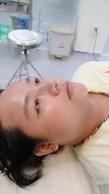 COMBO NÂNG MŨI CẤU TRÚC+ ĐỘN CẰM VỪA THỰC HIỆN XONG