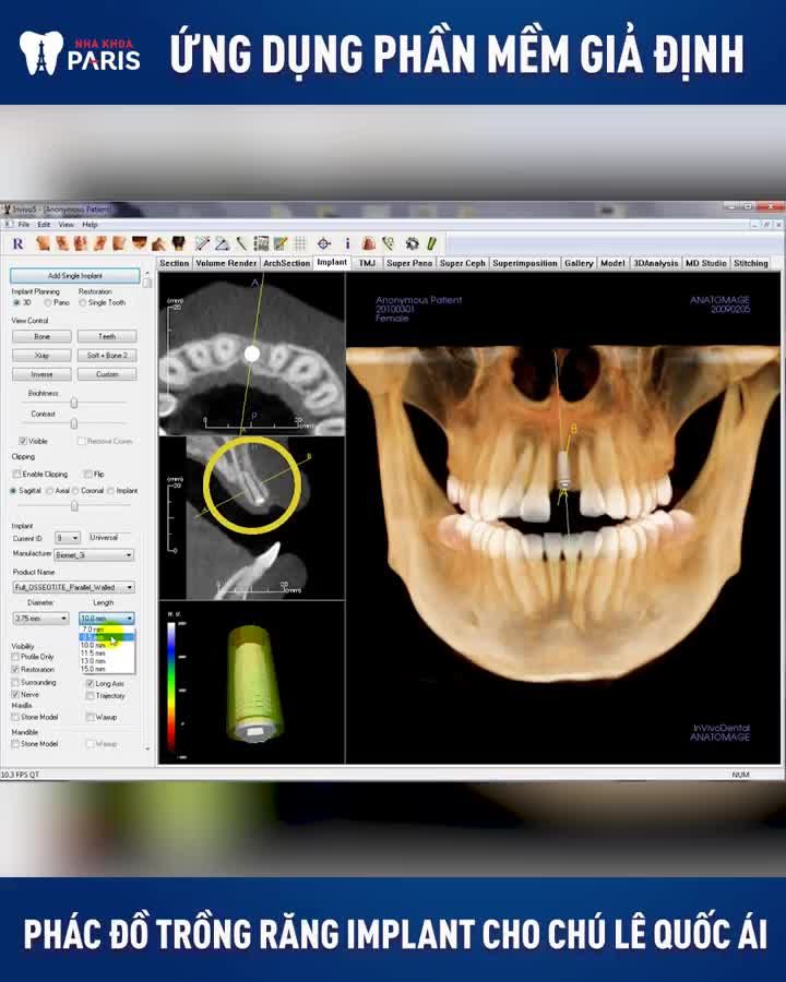 CHI TIẾT PHÁC ĐỒ TRỒNG RĂNG IMPLANT TRÊN PHẦN MỀM GIẢ ĐỊNH