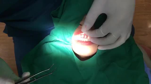 Lắp răng sứ cho chị Ngọc Anh tại nha khoa Thuỳ Anh.