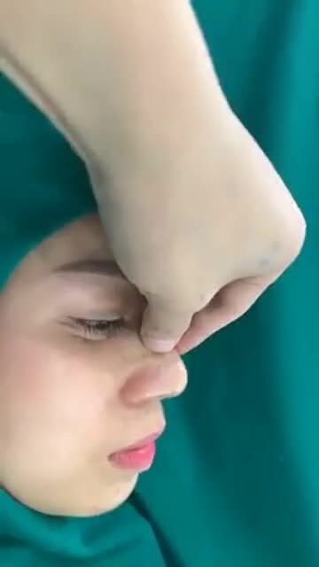 Mũi nhiều khuyết điểm thì nên xử lý thế nào?