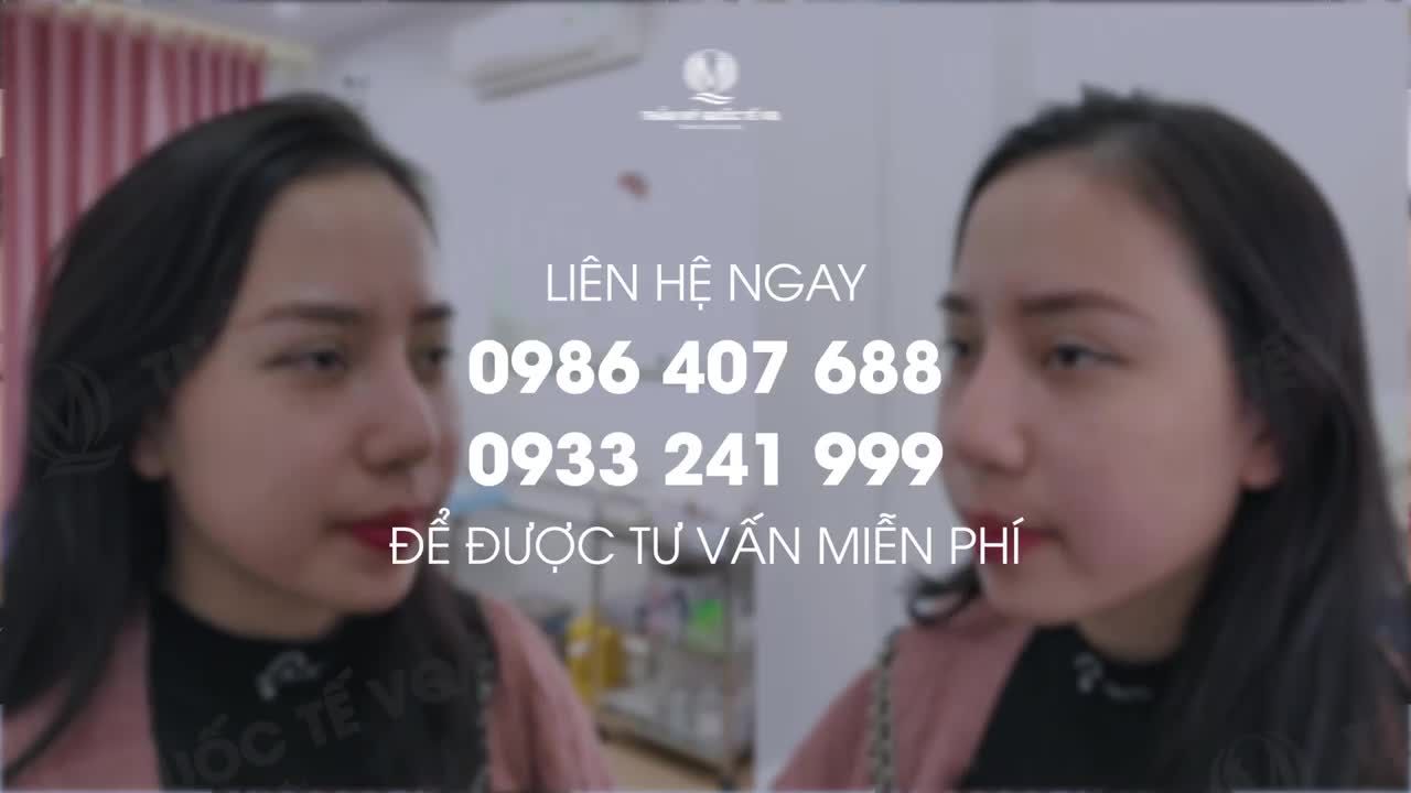 NÂNG MŨI SOFTLINE - MŨI CAO CHUẨN NHÂN TRẮC HỌC