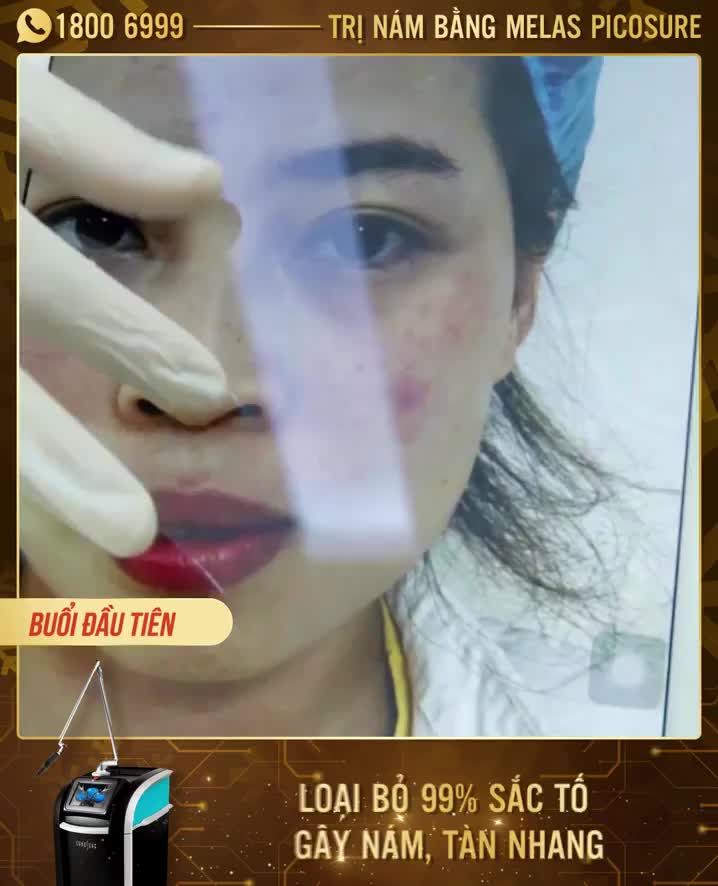 NGẠC NHIÊN VỚI KẾT QUẢ LÀN DA SAU KHI TRỊ NÁM MELAS PICOSURE
