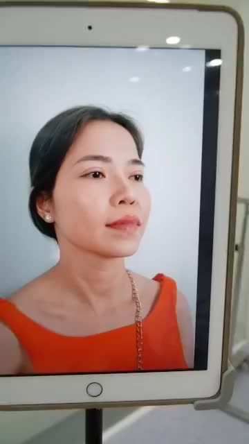 LỰA CHỌN NÂNG MŨI CẤU TRÚC SỬA LẠI TẠI DR.HOẠT - KHÁCH HÀNG "LỘT XÁC" HOÀN HẢO