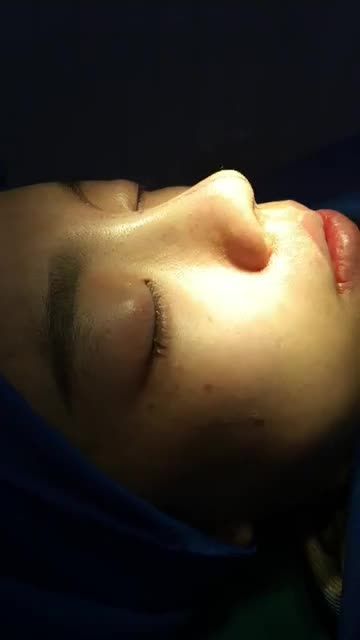 Nâng mũi bán cấu trúc 2 lớp