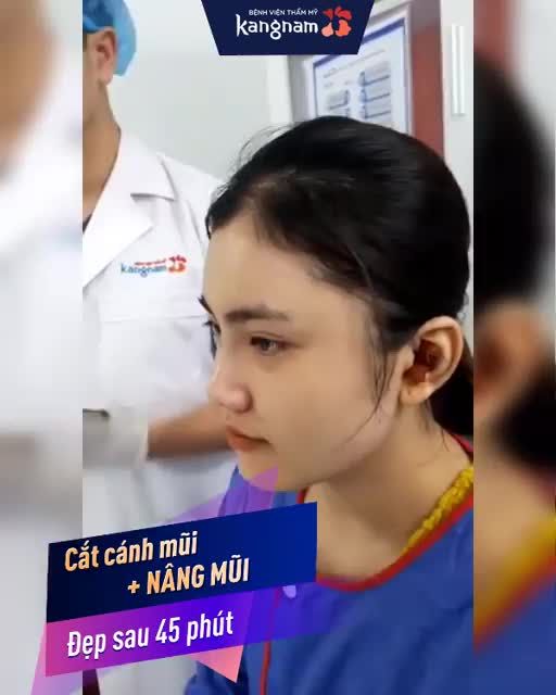 WOW! Mũi đẹp khó tin sau 45 phút [Nâng mũi cấu trúc 4D + Cắt cánh mũi
