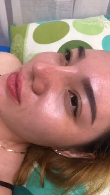 Nâng mũi bán cấu trúc