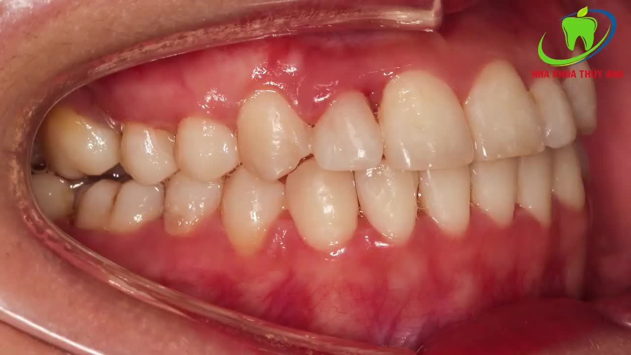 NIỀNG RĂNG CHỮA KHỚP CẮN NGƯỢC, THAY RĂNG MẤT BẰNG RĂNG THẬT, SỬA LỆCH ĐƯỜNG GIỮA.