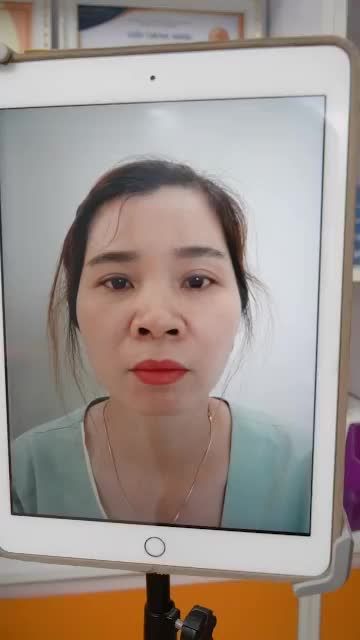 THÊM CASE MŨI CẤU TRÚC SỤN SURGIFORM ĐẸP MỸ MÃN SAU 10 NGÀY