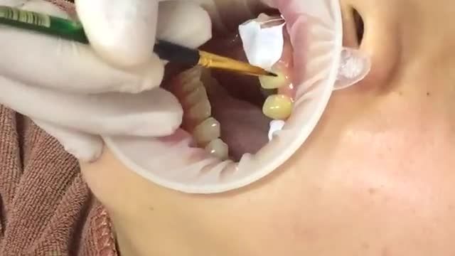 Dán sứ VENEER điều trị tình trạng răng thưa - không mài nhỏ răng