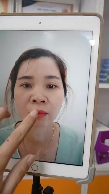 ĐỈNH CAO NÂNG MŨI CHẤT LIỆU SURGIFORM - CHỈ SAU 10 NGÀY DÁNG MŨI CHUẨN FORM HÀI HÒA