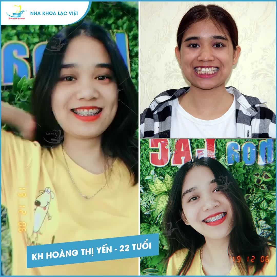 Niềng Răng "xóa sổ" tình trạng hô khấp khểnh - Với em đây là quyết định vô cùng SÁNG SUỐT