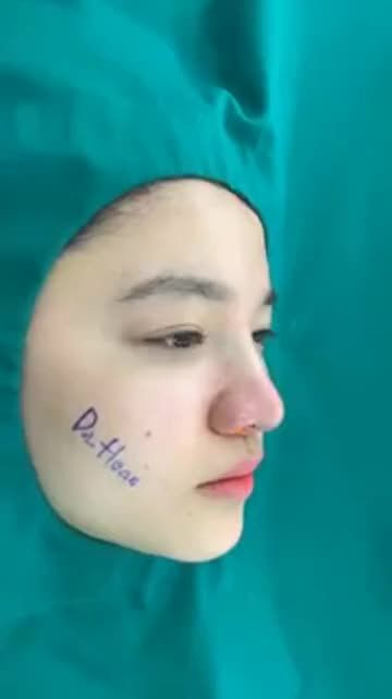 Quá trình chỉnh vẹo, sửa sống mũi