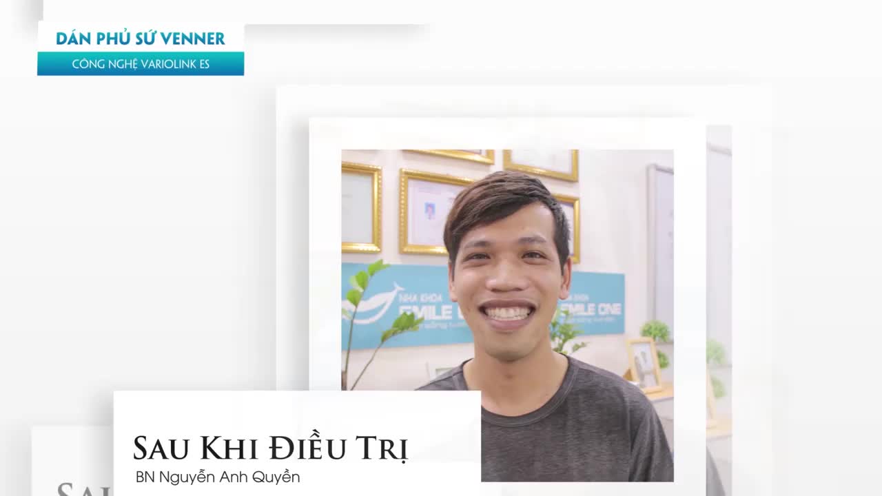 TRƯỚC ĐÂY, MỌI NGƯỜI HAY BẢO MÌNH CƯỜI THÌ CHE CÁI MỒM LẠI