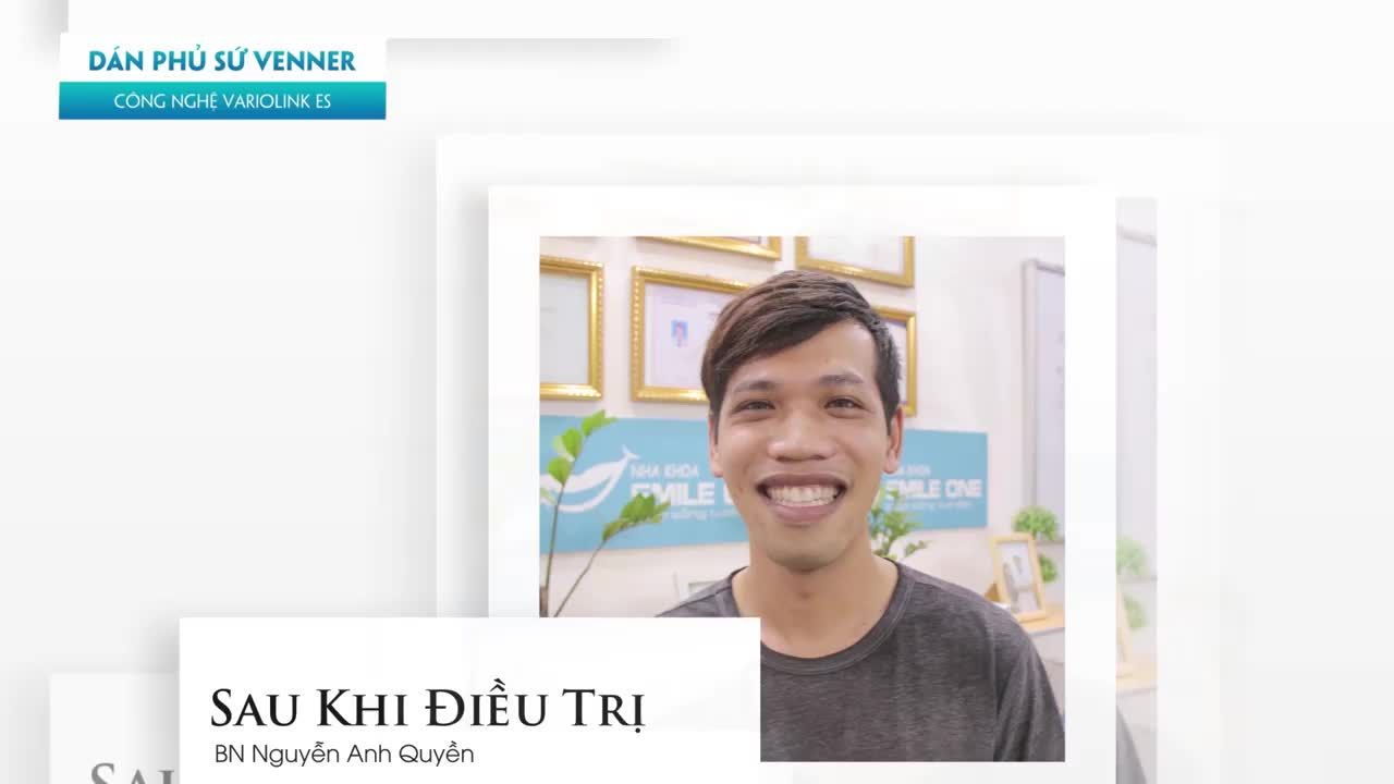 TRƯỚC ĐÂY, MỌI NGƯỜI HAY BẢO MÌNH CƯỜI THÌ CHE CÁI MỒM LẠI