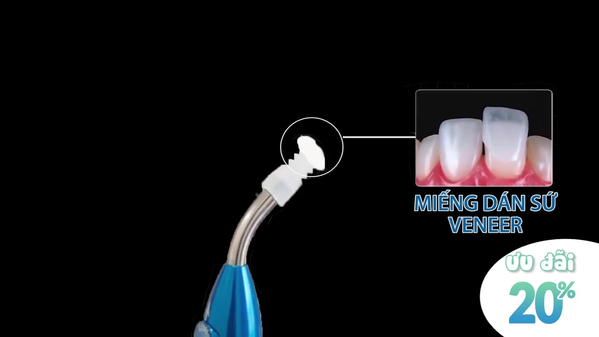 ƯU ĐÃI 20% - CƠ HỘI DÁN SỨ VENEER TIÊU CHUẨN CHÂU ÂU