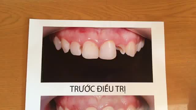 Gắn răng sứ cho chị Diệu tại Nha Khoa Thùy Anh.