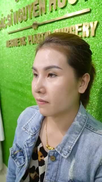 GẶP LẠI KHÁCH HÀNG SAU 2 TUẦN NÂNG MŨI TẠI DR.HOẠT
