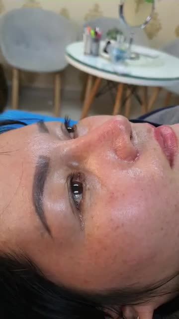 Nâng mũi bán cấu trúc Dáng Lline cao tây Quá đẹp cho em gái Tây Ninh