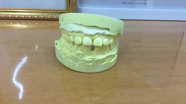 Tháo mắc cài hoàn thành chỉnh nha cho chị Mai.