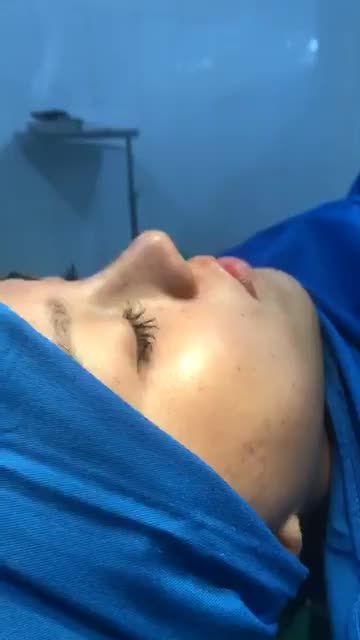 Nâng mũi Bán Cấu Trúc Sụn Tai 2 lớp