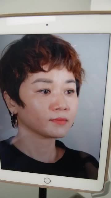 NÂNG MŨI CẤU TRÚC SAU 10 NGÀY THAY ĐỔI NHƯ THẾ NÀO