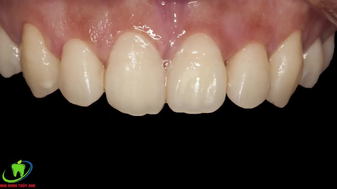 Chấm dứt hở lợi nụ cười của bạn sẽ như thế nào