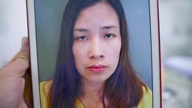 Giải cứu đôi mí mắt bẩm sinh, mắt cường cơ, sau khi CẮT MÍ MINI DEEP 5D đôi mắt trẻ đẹp, tràn đầy sức sống cho Khách hàng tại VTM DR HẢILÊ