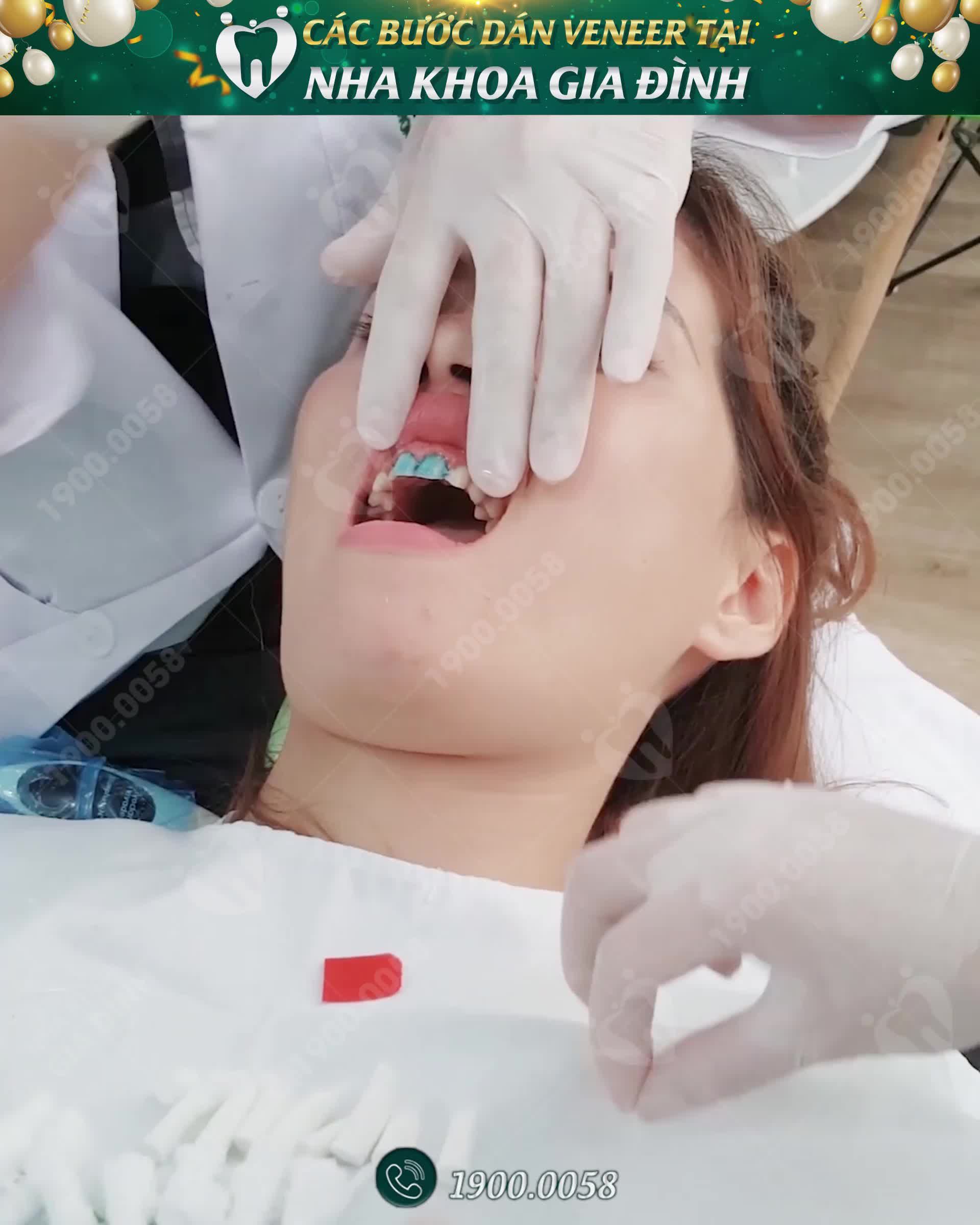 CẬN CẢNH DÁN SỨ VENEER TẠI NHA KHOA GIA ĐÌNH