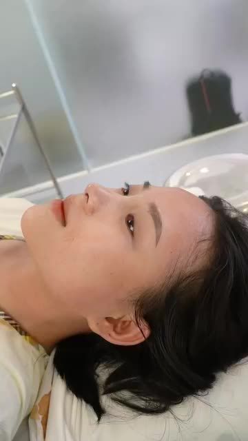 NÂNG MŨI CẤU TRÚC SURGIFORM - MŨI CAO SANG CHUẨN TỶ LỆ VÀNG