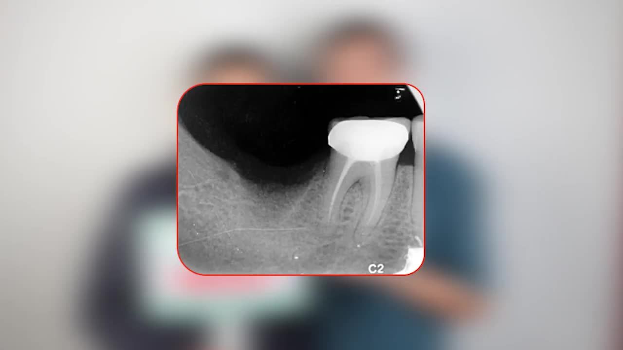 CẤY GHÉP IMPLANT KHÔNG ĐAU TẠI NHA KHOA THÙY ANH