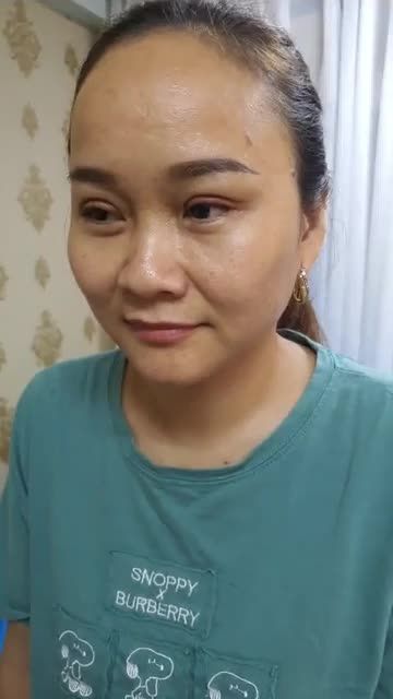 Cắt mắt 2 mí Dáng búp bê 9 ngày tuổi các bạn nhen