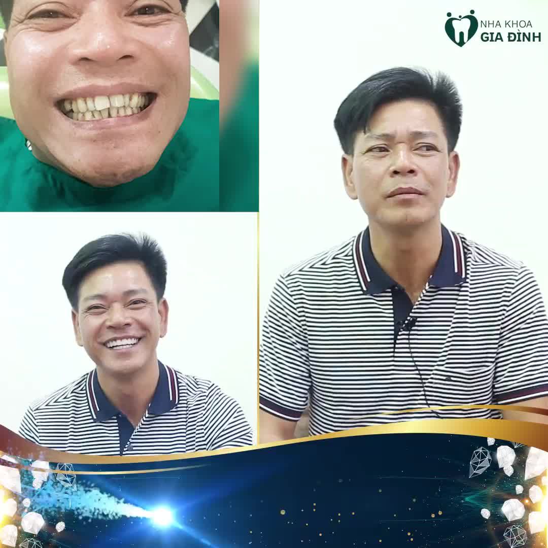 Cảm giác ăn nhai khó và hàm răng quá mất thẩm mỹ đến độ anh Trọng phải thốt lên câu: "Hết chịu nổi rồi, phải làm lại răng ngay thôi".