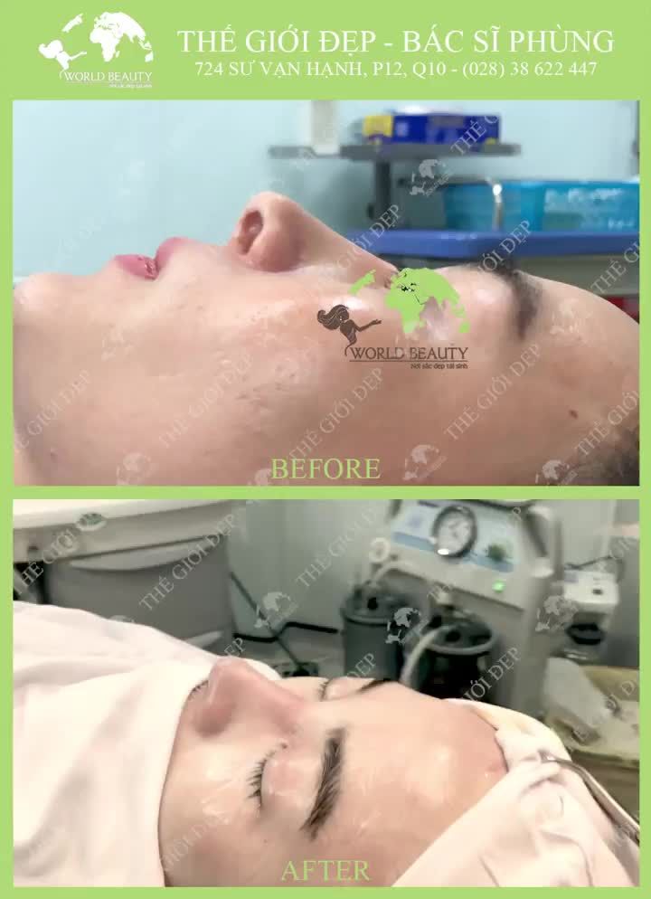Dành cả thanh xuân để đi sửa mũi
