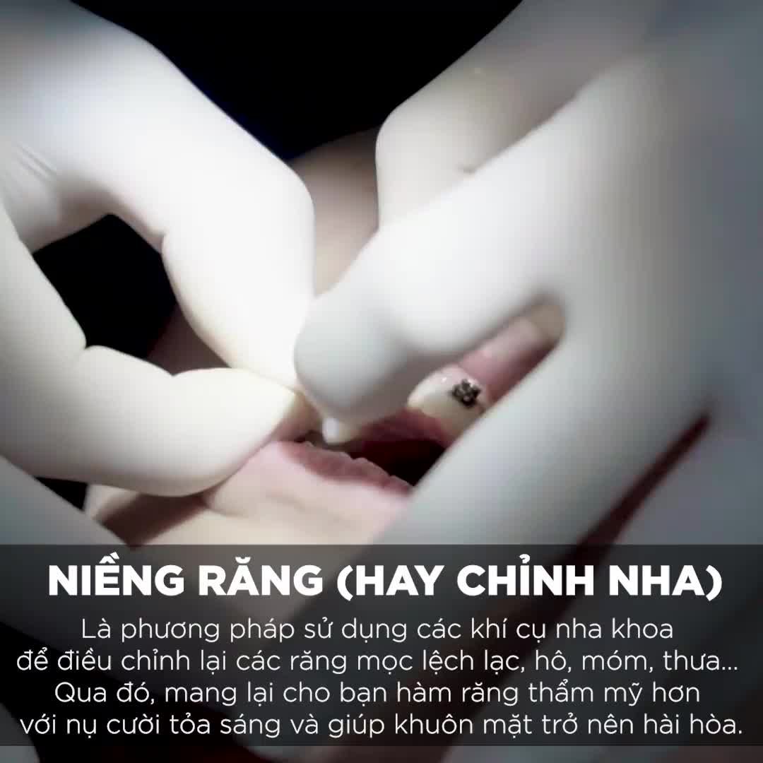 NIỀNG RĂNG - Lột Xác Chỉ Sau 6 Tháng