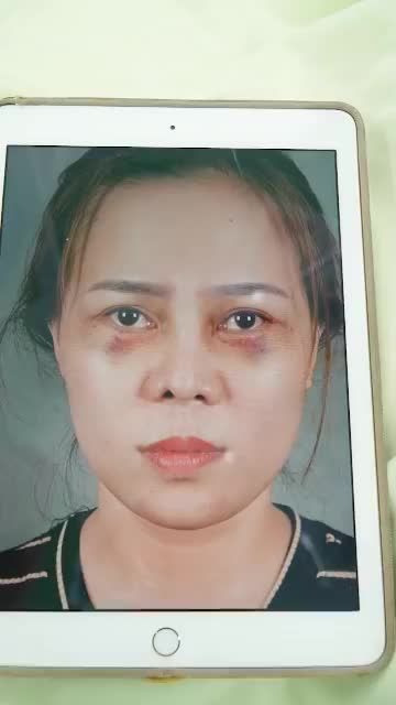 NÂNG MŨI CẤU TRÚC SỤN SƯỜN VỪA THỰC HIỆN XONG – MŨI CAO ĐÓN TẾT SANG