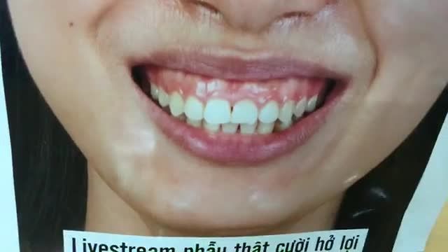 Điều trị cười hở lợi cho ban Hồng Minh đến từ Thanh Hoá.