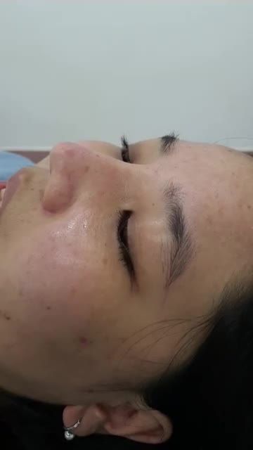 Nâng mũi sụn tai 2 lớp Dáng Sline kết hợp Lline